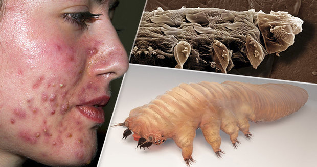 Cancer limfatic simptome cauze - etigararunway.ro Paraziti hmyzu